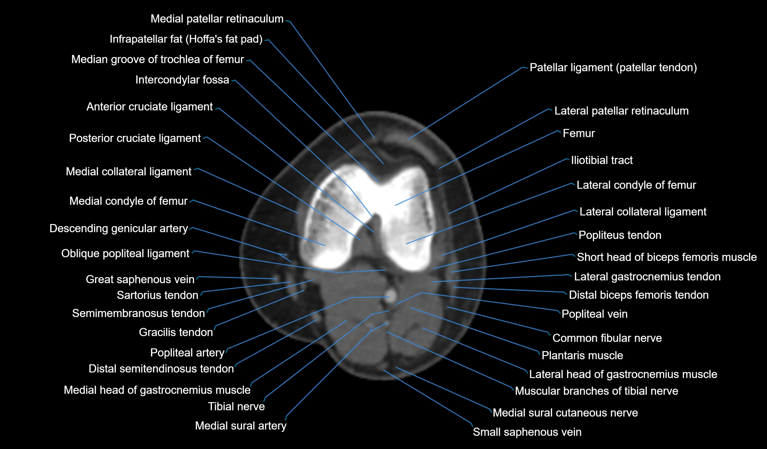 CT knee axial cross sectional anatomy labelled image-00033.webp